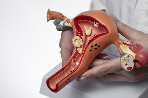Cirugía para cáncer de ovario ofrecida por él Dr. Carlos Morales Camacho